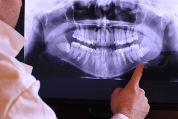 Teeth Whitening in LA