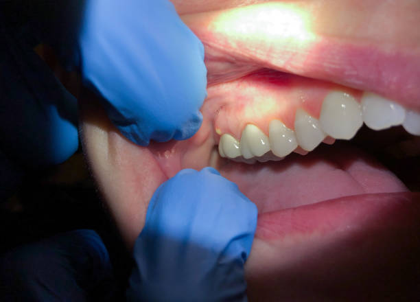 Best Tooth Infection Emergency Dentist  in Natchitoches, LA